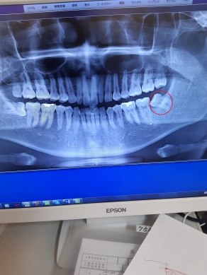 歯のレントゲン写真