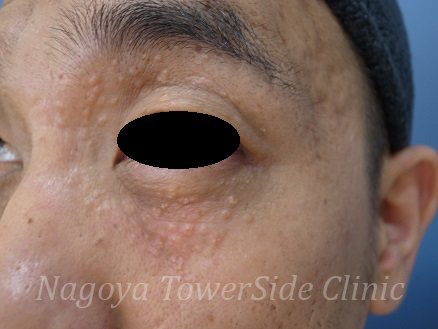 目 の 周り の プツプツ 稗粒腫はハトムギ化粧水で治せる 目の下の白いプツプツがすっきり